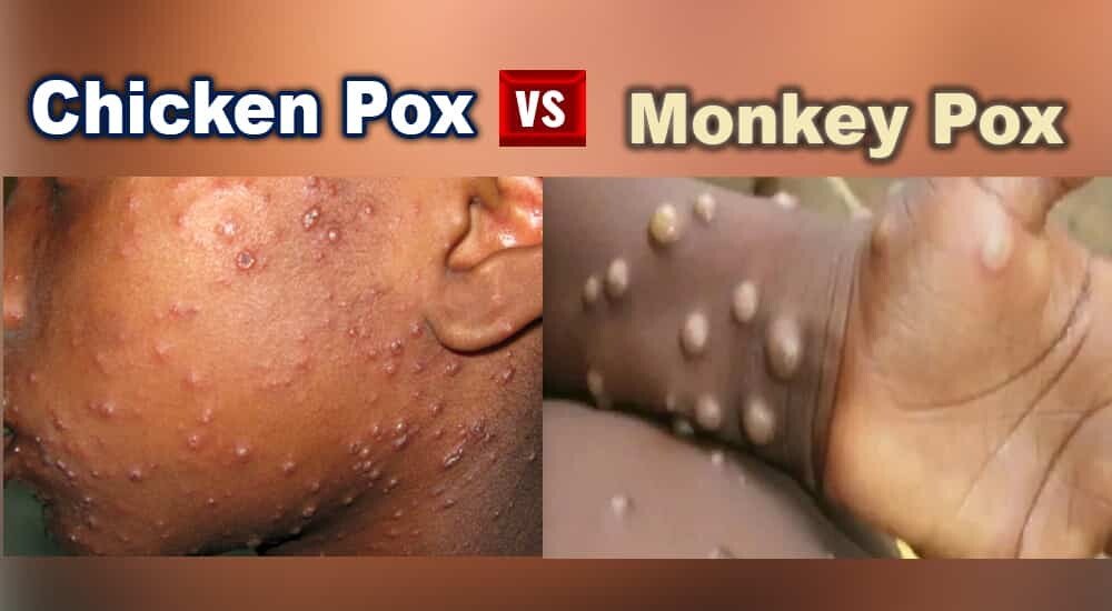 chicken pox vs monkey pox 1